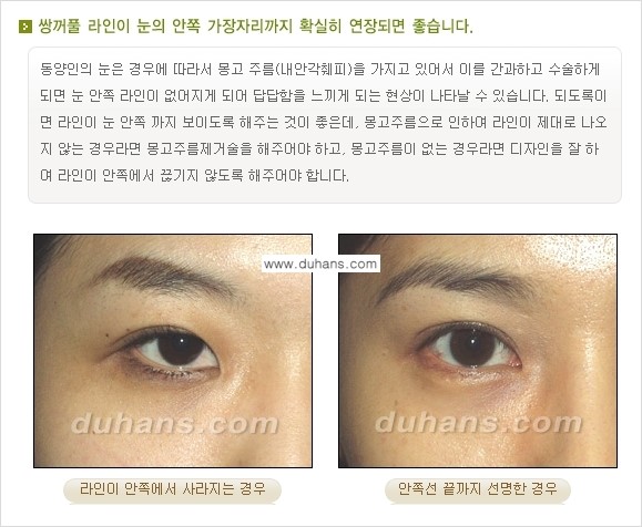 [두한성형외과 경쟁력 눈성형] - [매력적이고 아름다운 쌍꺼풀이란?] 관련 이미지 3