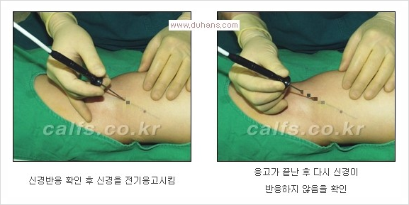 ⁠⁠[두한성형외과 경쟁력 종아리성형] - [굵은 다리의 모양과 원인에 따른 종아리성형 방법] 관련 이미지 9