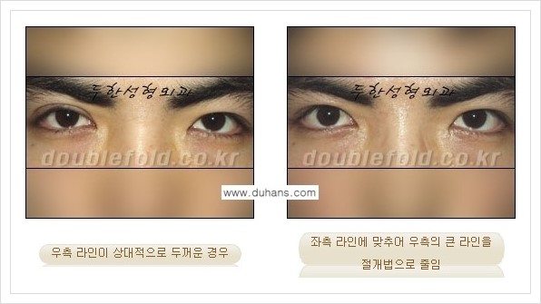 [두한성형외과 경쟁력 눈성형] - [짝짝이(비대칭) 쌍꺼풀 라인 교정하는 방법 안내 1.] 관련 이미지 7