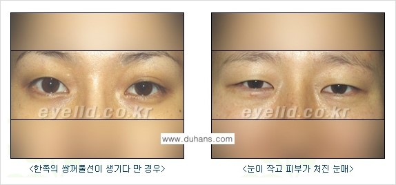 [두한성형외과 성형 FOCUS] - [퀵쌍꺼풀 수술 ②] 관련 이미지 1