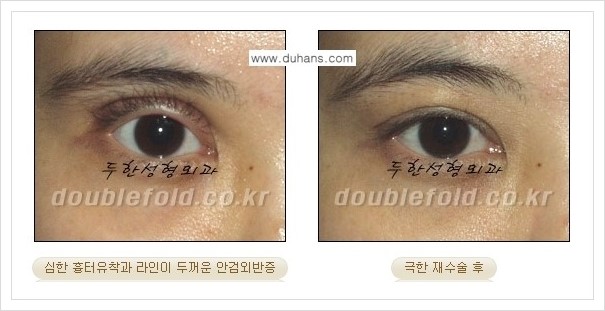 [두한성형외과 경쟁력 쌍꺼풀 재수술, 극한 눈재수술] - [쌍꺼풀 재수술, 극한 눈재수술 관련 자주하는 질문과 답변] 관련 이미지 7