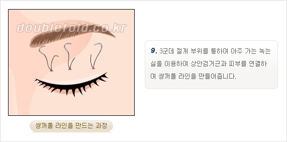 [두한성형외과 경쟁력 쌍꺼풀 재수술, 극한 재수술] - [쌍꺼풀 재수술의 과정 안내 2.] 관련 이미지 12
