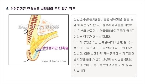 ​​[두한성형외과 경쟁력 쌍꺼풀(눈) 재수술] - [쌍꺼풀(눈) 재수술 실패의 원인 분석 안내] 관련 이미지 7