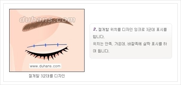 [두한성형외과 경쟁력 눈성형, 쌍꺼풀 수술] - [퀵쌍꺼풀(부분절개법)의 수술 안내] 관련 이미지 3