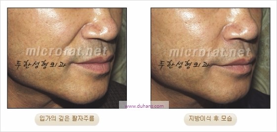 [두한성형외과 경쟁력 주름성형] - [젊어 보이는 입가팔자주름 지방이식] 관련 이미지 20