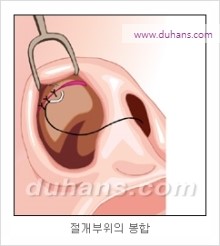 [두한성형외과 경쟁력 코성형 리더] - [자연스럽고 오똑한 콧망울! 코성형 방법]​ 관련 이미지 10