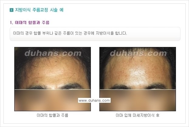 ​[두한성형외과 경쟁력 주름성형] - [주름교정을 위한 미세지방이식 안내 1.] 관련 이미지 11