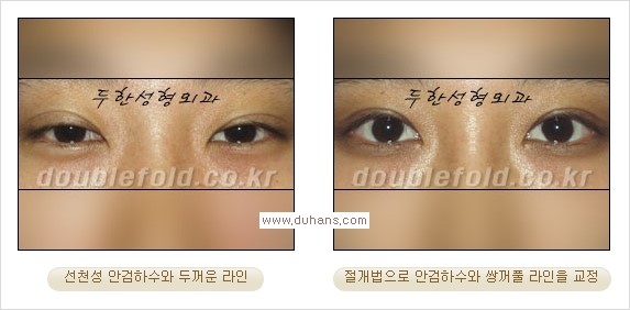 [두한성형외과 경쟁력 쌍꺼풀 재수술, 극한 눈재수술] - [안검하수 검사 및 수술방법 안내] 관련 이미지 11