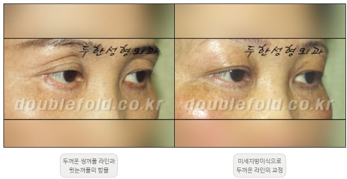 [Duhan Plastic Surgery Double Eyelid Revision] - [Thick Double Eyelid Line] image 26