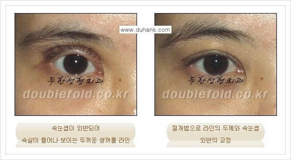 [두한성형외과 경쟁력 쌍꺼풀 재수술, 극한 재수술] - [망가진 눈 복원수술 - 속눈썹 외반 교정 안내] 관련 이미지 2