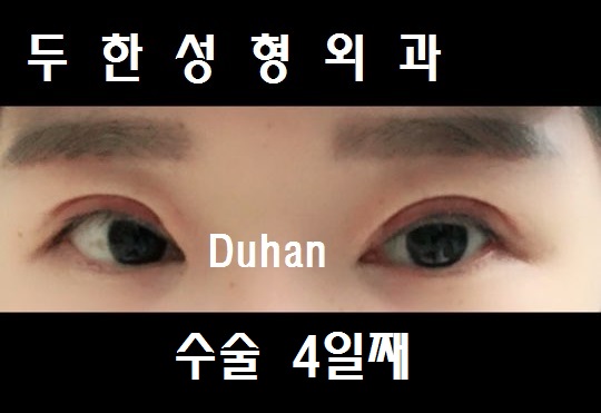 #아웃라인 #비대칭라인 에서 #인아웃라인 으로 #쌍꺼풀재수술 #다크써클 관련 이미지 3