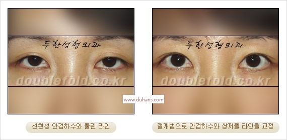 ⁠⁠[두한성형외과 경﻿쟁력 쌍꺼풀 재수술] - [안검하수(졸리운 눈매) 종류와 교정 방법 안내] 관련 이미지 26