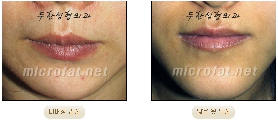 [Duhan Plastic Surgery Lip Surgery] - [Lip Correction Fat Grafting] image 1
