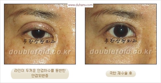 [두한성형외과 경쟁력 눈성형] - [극한 재수술, 함몰된 눈꺼풀 라인교정, 안검하수(졸리운 눈매)] 관련 이미지 13