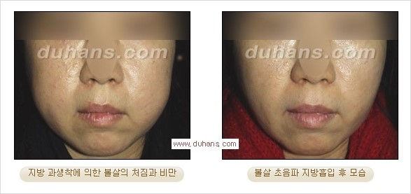 [두한성형외과 경쟁력 지방흡입] - [얼굴, 볼살, 턱살, 턱선의 초음파 지방흡입] 관련 이미지 20
