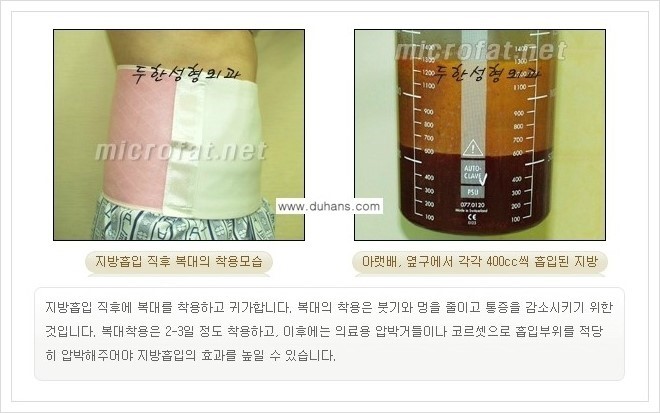 [두한성형외과 경쟁력 맞춤 바디성형] - [간편한 아랫배, 윗배, 허리, 옆구리살, 허벅지, 엉덩이, 복부지방흡입술, 팔뚝(상완부) 지방흡입술 안내] 관련 이미지 8