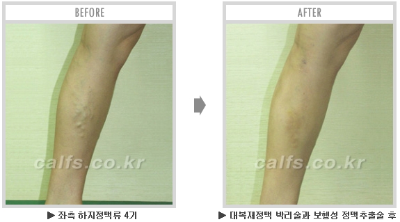 [종아리성형 두한성형외과] - [종아리수술에 대한 자주하는 질문과 답변 모음] 관련 이미지 15