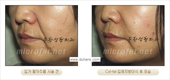 [두한성형외과 경쟁력 미세지방이식] - [Col-fat(콜펫) 지방이식의 특징과 차이점 안내] 관련 이미지 8
