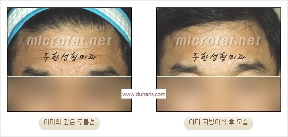 [두한성형외과 경쟁력 동안성형 리더] - ​[미간주름, 이마주름, 안검성형, 이마거상술, 눈썹거상술] 관련 이미지 33