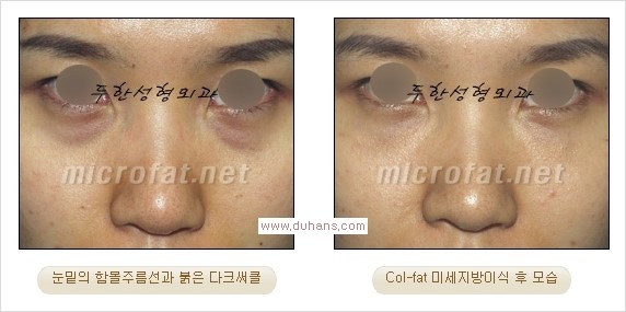 [두한성형외과 경쟁력 눈밑성형] - [눈밑 미세지방이식으로 다크써클 치료] 관련 이미지 20