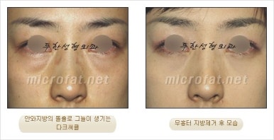 두한성형외과 눈밑수술 - 다크서클 수술 전후 관리 안내 관련 이미지 66