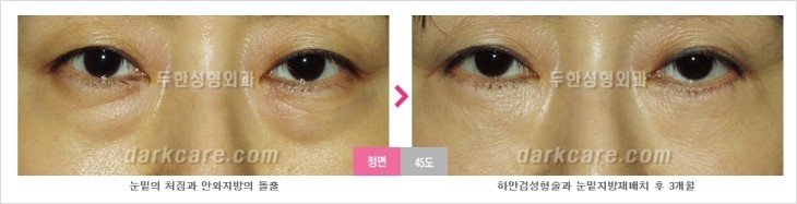 ​[두한성형외과 경쟁력 눈밑성형 리더] - [눈밑 다크써클의 증상, 원인, 종류, 치료방법 안내] 관련 이미지 60