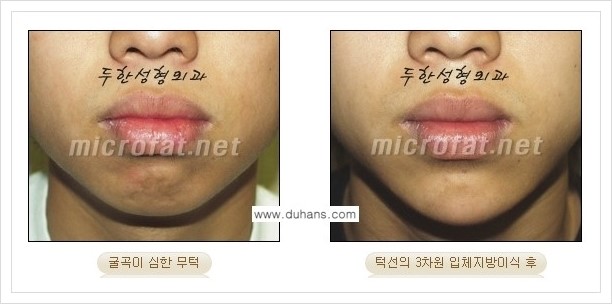 [두한성형외과 경쟁력 안면윤곽 교정] - [미세지방이식으로 무턱, 작은턱, 오목턱, 턱선의 비대칭 교정 안내] 관련 이미지 12