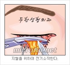 두한성형외과 눈밑성형 - 눈밑지방제거, 눈밑주름, 눈밑지방재배치 관련 이미지 7