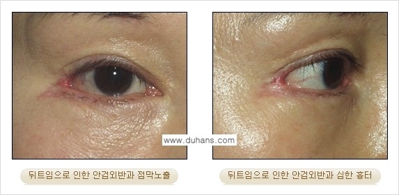 [두한성형외과 No.1 경쟁력] - [앞트임 복원 수술, 뒤트임 복원 수술] 관련 이미지 12