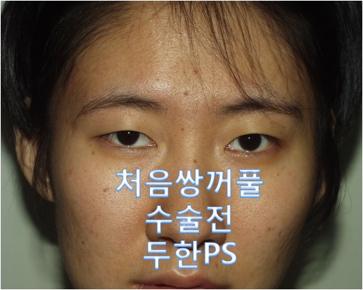 [두한ps]- #쌍꺼풀 처음수술 #완전절개 #답답해보이는 눈매교정 관련 이미지 2