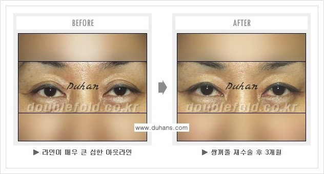 ⁠⁠⁠[두한성형외과 경쟁력 쌍꺼풀 재수술, 극한 재수술] - [쌍꺼풀 재수술시 잘못된 수술로 넓어진 흉터선 교정 안내] 관련 이미지 8