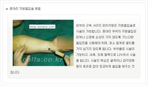 [두한성형외과 경쟁력 멀티종아리성형] - [나에게 맞는 종아리성형 방법의 종류 안내 3.] 관련 이미지 1