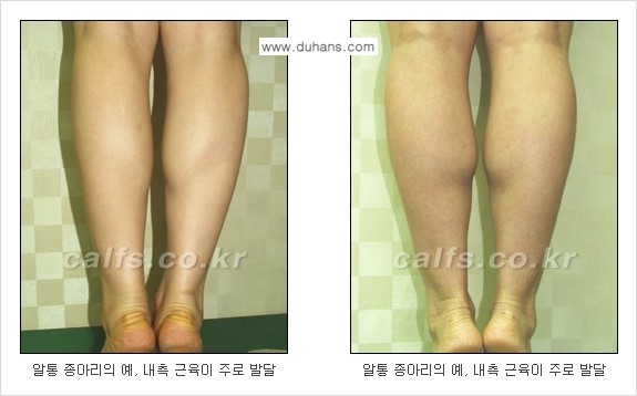 [두한성형외과 경쟁력 멀티종아리성형] - [굵은 알통 종아리 수술 안내 2.] 관련 이미지 4