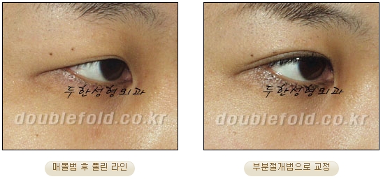 [두한성형외과 쌍커풀수술] - [눈성형 방법에 대한 자주하는 질문과 답변] 관련 이미지 53