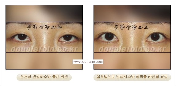 [두한성형외과 경쟁력 쌍꺼풀 재수술, 극한 눈재수술] - [안검하수 검사 및 수술방법 안내] 관련 이미지 14