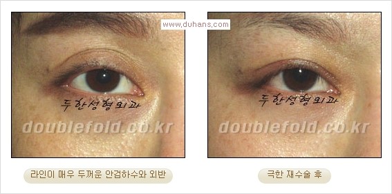 Dr. 컬럼 - 쌍꺼풀 재수술의 부작용을 최소화하는 극한 눈재수술 관련 이미지 8
