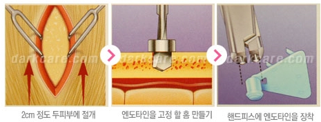 Duhan Plastic Surgery Combo Program - Dark Circles and Lifting image 19