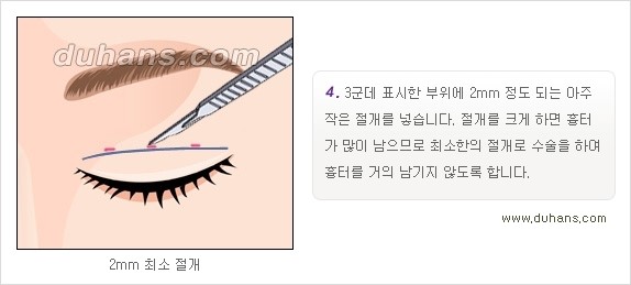 ​[두한성형외과 경쟁력 눈성형] - [자연스럽고 아름다운 쌍꺼풀의 기준] 관련 이미지 10