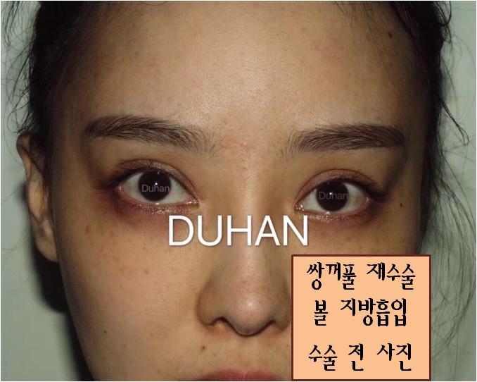 [두한성형외과] - [쌍꺼풀재수술, 눈재수술, 쌍꺼풀라인낮추기, 볼지방흡입, V라인] 관련 이미지 2