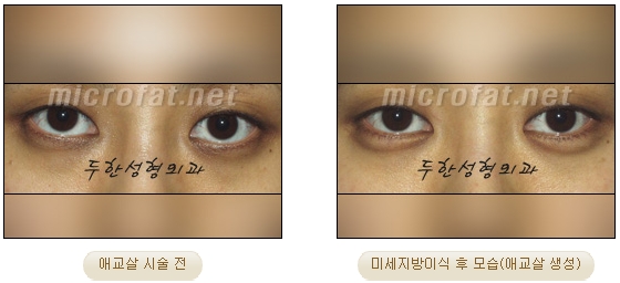 ​[두한성형외과 지방이식] - [애교살] 관련 이미지 15