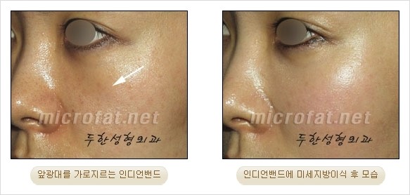 지방이식 두한성형외과 - 입가팔자주름, 인디언주름 지방이식 관련 이미지 31