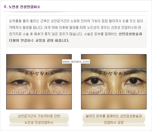 [두한성형외과 경쟁력 눈성형] - [안검하수(졸린 눈매) 재수술 안내 ①] 관련 이미지 8