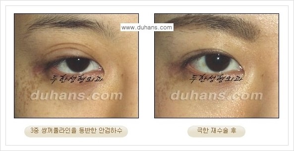 [두한성형외과 경쟁력 망가진 눈 복원수술] - [두꺼운 라인을 교정하는 극한 재수술(Extreme Reoperation) 안내] 관련 이미지 8