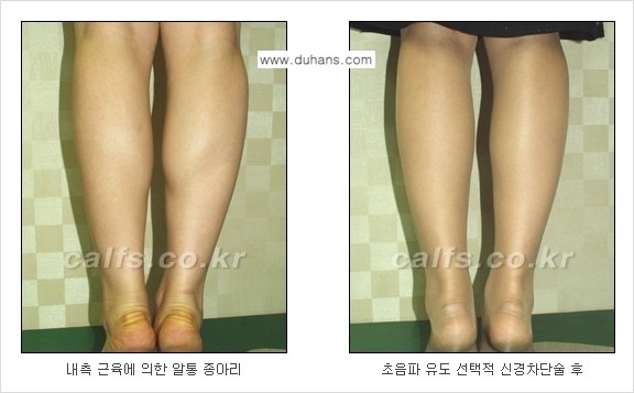 ​[두한성형외과와 날씬한 종아리 만들기!] - [간편하고 안전한 종아리 축소방법 ③] 관련 이미지 12