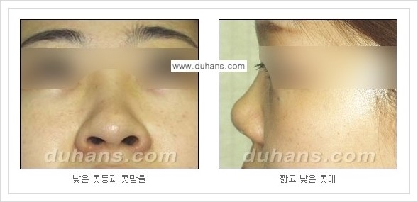 [두한성형외과 경쟁력 미세지방이식] - [코 미세지방이식 안내] 관련 이미지 3