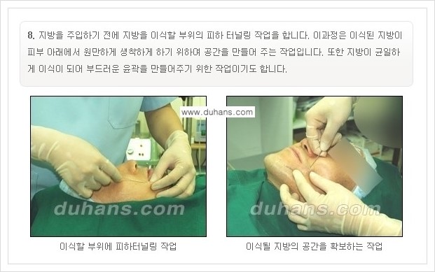 [두한성형외과 경쟁력 미세지방이식] - [부드럽고 아름다운 얼굴선 만들기, 얼굴 미세지방이식 과정 안내] 관련 이미지 7