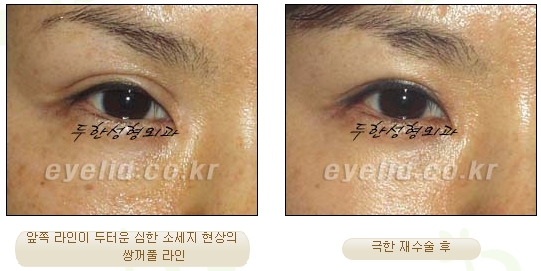 Duhan Plastic Surgery Ophthalmic Reoperation - What Is a Successful Double Eyelid Revision Surgery? image 31