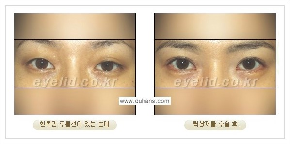 [두한성형외과 경쟁력 눈성형] - [퀵쌍꺼풀 - 부분절개법] 관련 이미지 5