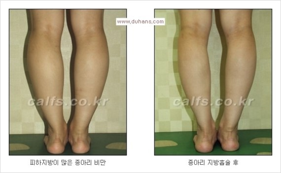 [두한성형외과 경쟁력 종아리성형 리더] - [종아리 성형 안내] 관련 이미지 12