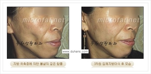 [두한성형외과 경쟁력 볼살지방이식] - [사각턱의 경우, 측면 볼살의 함몰선, 안면비대칭, 남성 야윈볼살 안내] 관련 이미지 6